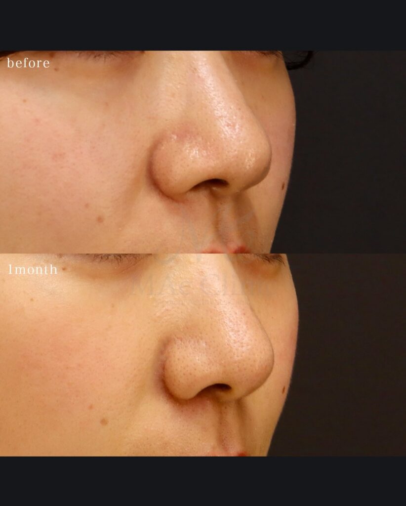 小鼻縮小（内外側法） 望月正人医師症例