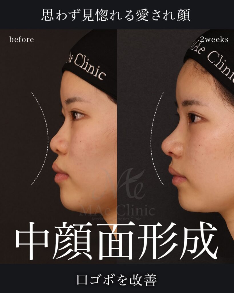 鼻中隔延長（肋軟骨）
鼻尖形成
鼻尖軟骨移植
鼻背細片軟骨移植（隆鼻術）
猫貴族手術（肋軟骨）
前田翔医師症例