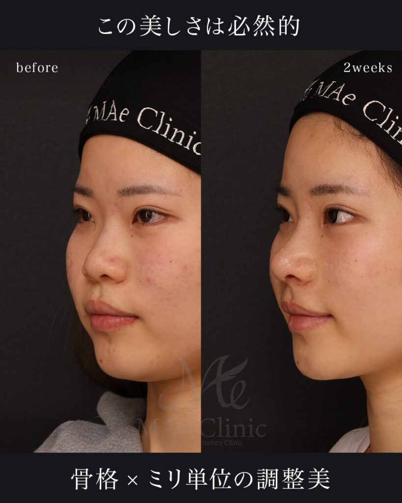 鼻中隔延長（肋軟骨） 鼻尖形成 鼻尖軟骨移植 鼻背細片軟骨移植（隆鼻術） 猫貴族手術（肋軟骨） 前田翔医師症例