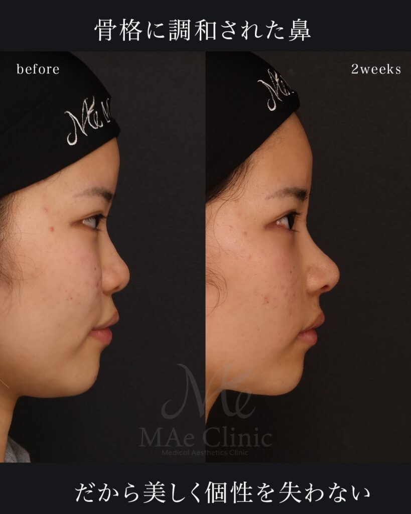 鼻中隔延長（肋軟骨） 鼻尖形成 鼻尖軟骨移植 鼻背細片軟骨移植（隆鼻術） 猫貴族手術（肋軟骨） 前田翔医師症例