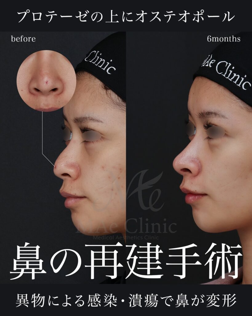 鼻中隔延長（肋軟骨） 猫貴族手術 隆鼻（肋軟骨） 鼻尖形成 鼻尖軟骨移植 他院プロテーゼ抜去 前田翔医師症例