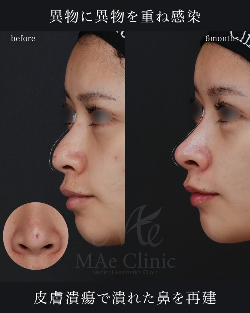 鼻中隔延長（肋軟骨） 猫貴族手術 隆鼻（肋軟骨） 鼻尖形成 鼻尖軟骨移植 他院プロテーゼ抜去 前田翔医師症例