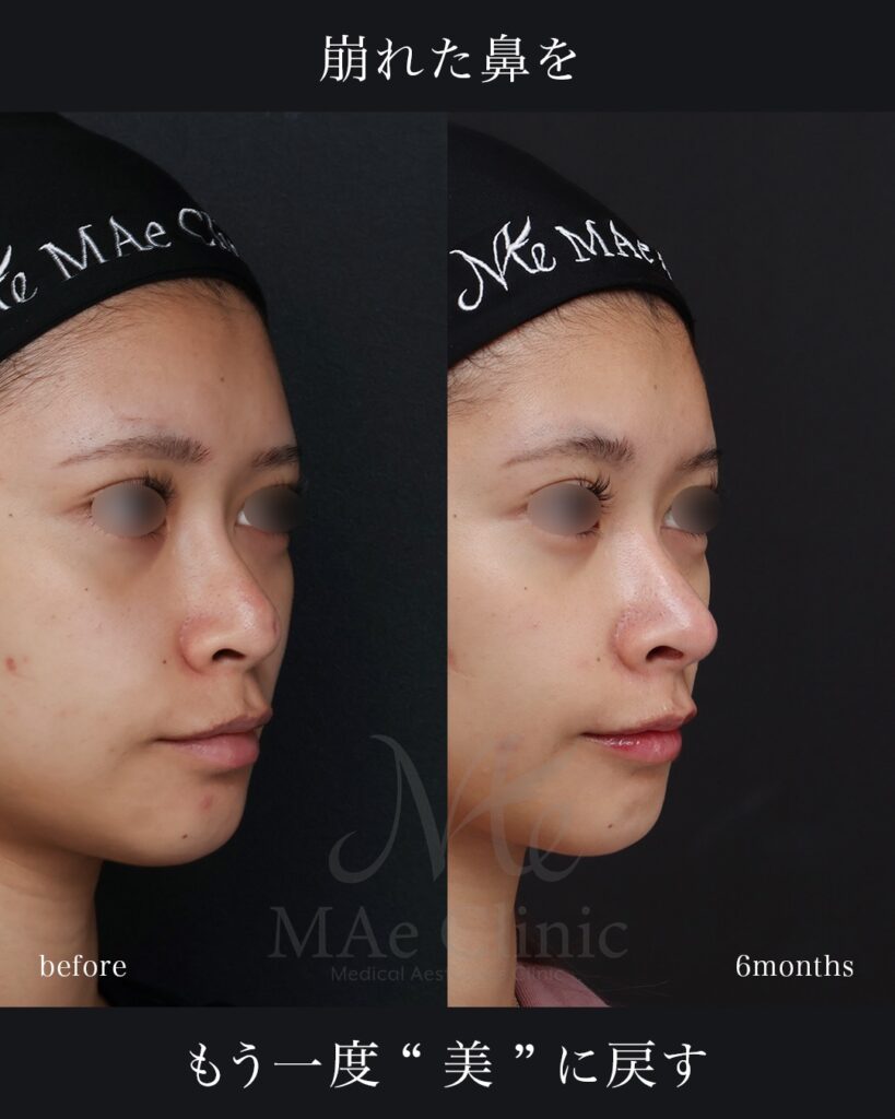 鼻中隔延長（肋軟骨） 猫貴族手術 隆鼻（肋軟骨） 鼻尖形成 鼻尖軟骨移植 他院プロテーゼ抜去 前田翔医師症例