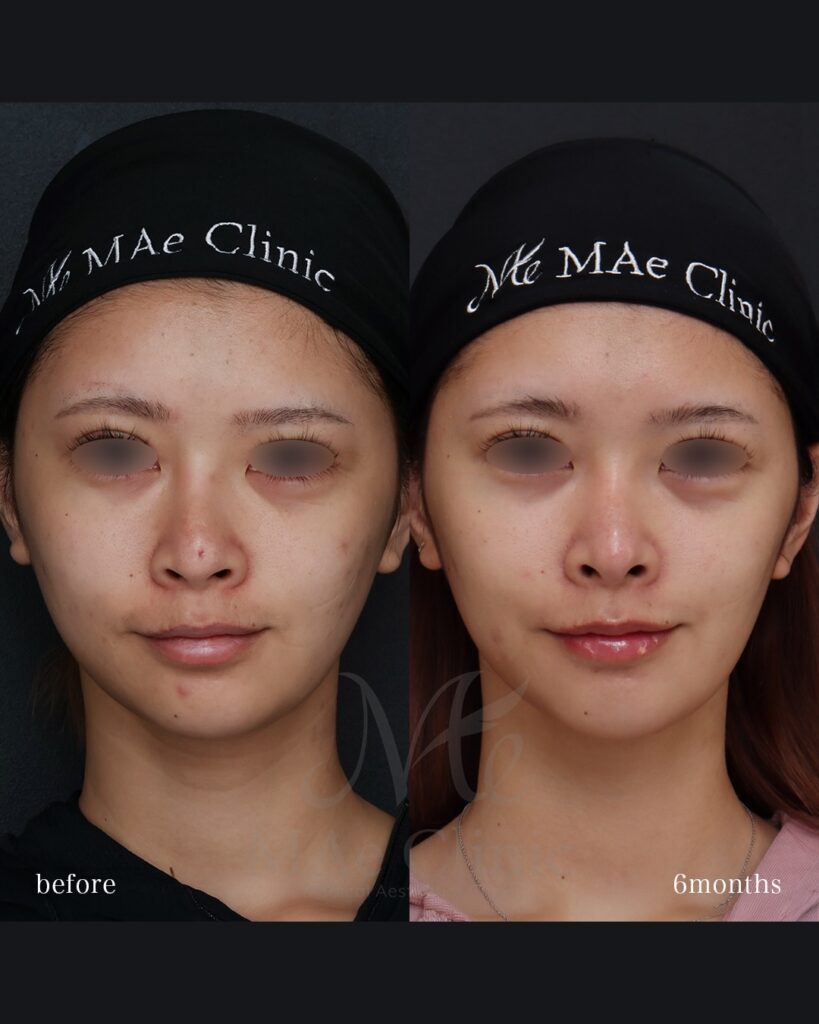 鼻中隔延長（肋軟骨） 猫貴族手術 隆鼻（肋軟骨） 鼻尖形成 鼻尖軟骨移植 他院プロテーゼ抜去 前田翔医師症例