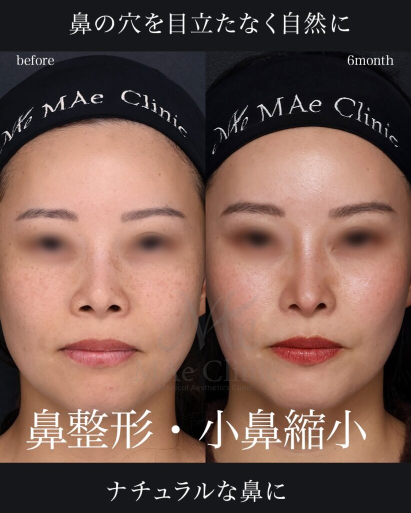 鼻中隔延長(肋軟骨)
鼻尖形成
鼻尖軟骨移植
小鼻縮小
望月正人医師症例