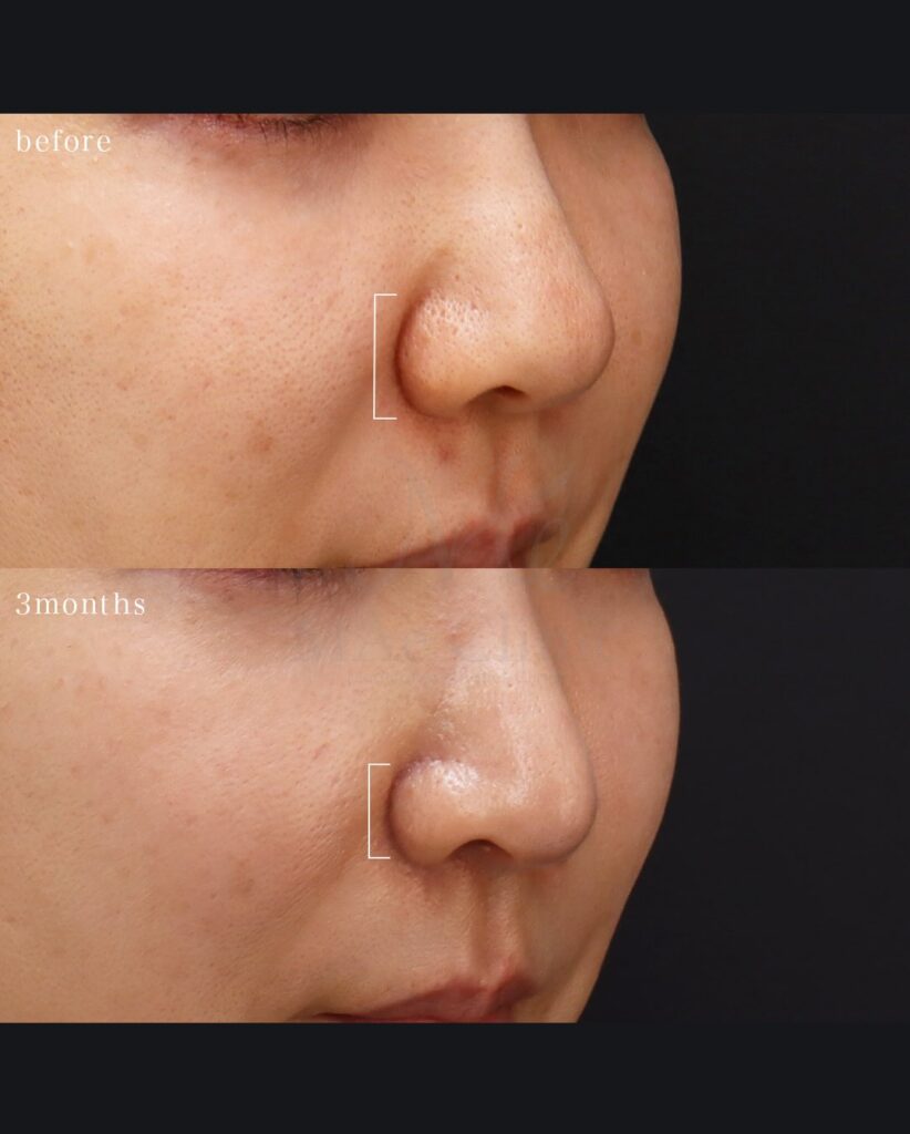 鼻翼挙上 鼻尖形成 鼻尖軟骨移植 望月正人医師症例