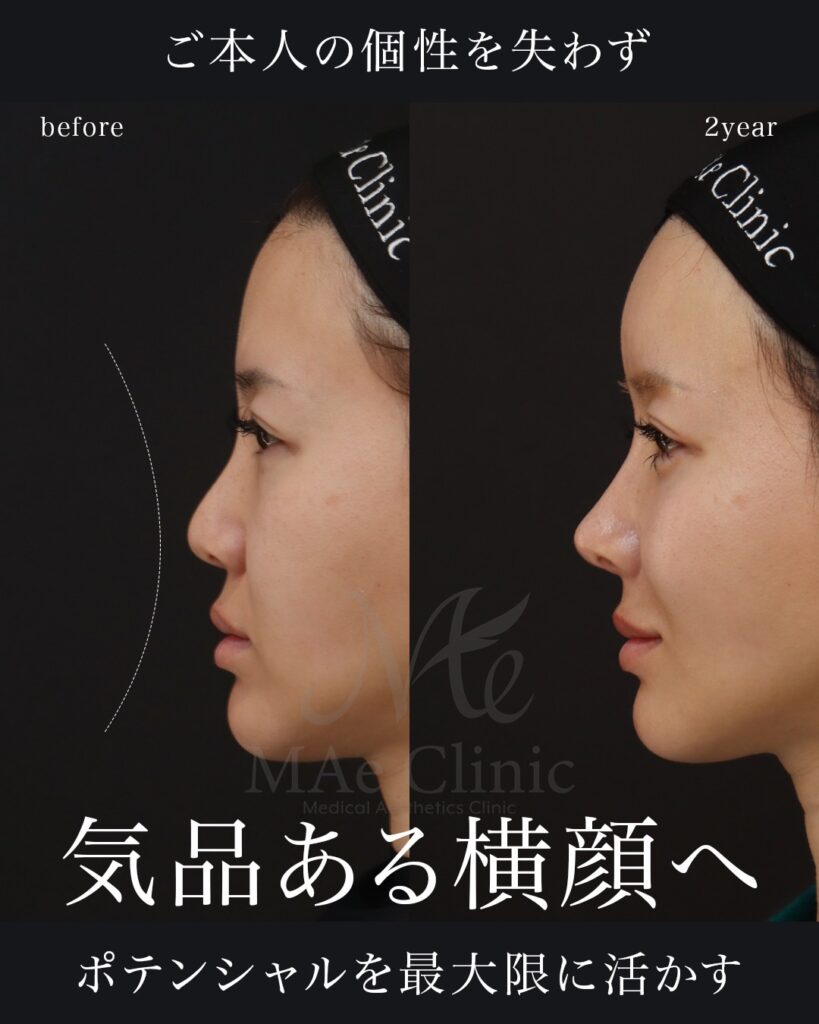 鼻中隔延長（肋軟骨）
鼻尖形成
鼻尖軟骨移植
隆鼻(肋軟骨)
鼻孔縁下降
猫貴族手術
他院プロテーゼ抜去
脂肪注入(額＋こめかみ)
前田翔医師症例