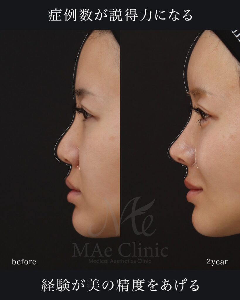 鼻中隔延長（肋軟骨） 鼻尖形成 鼻尖軟骨移植 隆鼻(肋軟骨) 鼻孔縁下降 猫貴族手術 他院プロテーゼ抜去 脂肪注入(額＋こめかみ) 前田翔医師症例