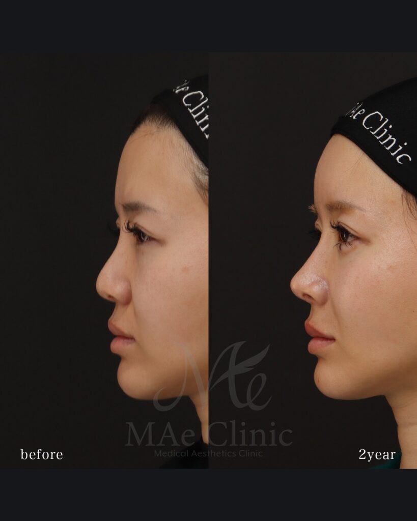 鼻中隔延長（肋軟骨） 鼻尖形成 鼻尖軟骨移植 隆鼻(肋軟骨) 鼻孔縁下降 猫貴族手術 他院プロテーゼ抜去 脂肪注入(額＋こめかみ) 前田翔医師症例