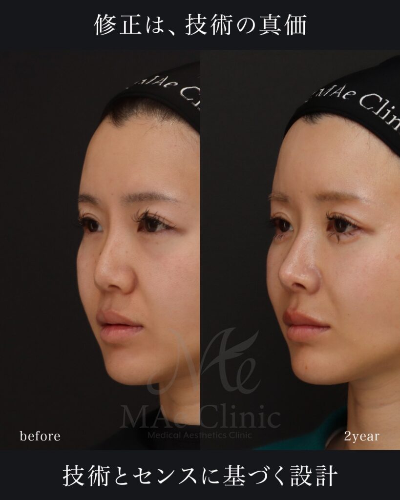 鼻中隔延長（肋軟骨） 鼻尖形成 鼻尖軟骨移植 隆鼻(肋軟骨) 鼻孔縁下降 猫貴族手術 他院プロテーゼ抜去 脂肪注入(額＋こめかみ) 前田翔医師症例