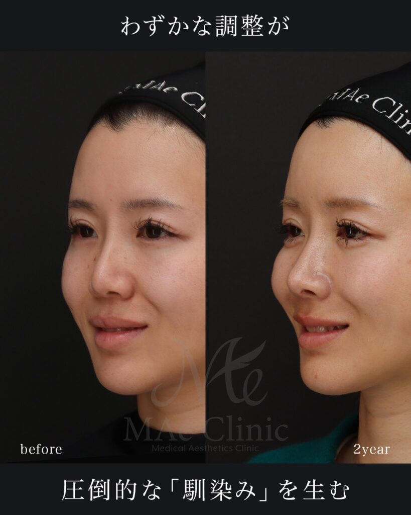 鼻中隔延長（肋軟骨） 鼻尖形成 鼻尖軟骨移植 隆鼻(肋軟骨) 鼻孔縁下降 猫貴族手術 他院プロテーゼ抜去 脂肪注入(額＋こめかみ) 前田翔医師症例