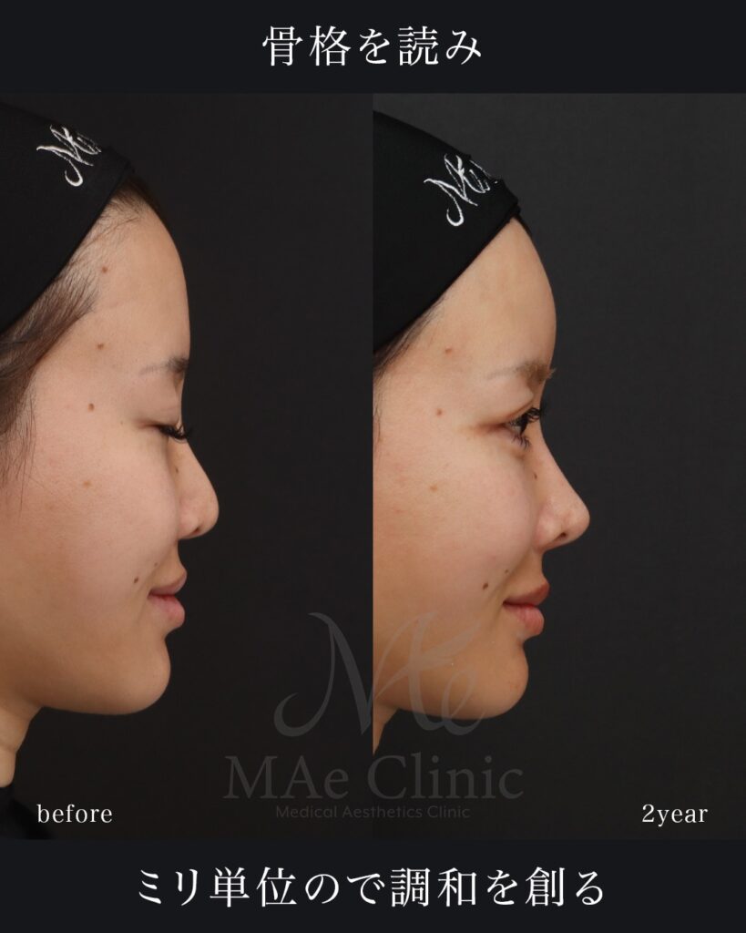 鼻中隔延長（肋軟骨） 鼻尖形成 鼻尖軟骨移植 隆鼻(肋軟骨) 鼻孔縁下降 猫貴族手術 他院プロテーゼ抜去 脂肪注入(額＋こめかみ) 前田翔医師症例