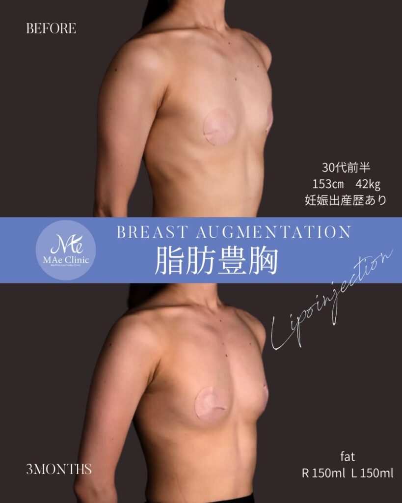 脂肪注入豊胸（遠心分離法）
脂肪採取部位：大腿後面（太もも裏）
注入量：300ml（右150ml / 左150ml）
木下恵里沙医師症例