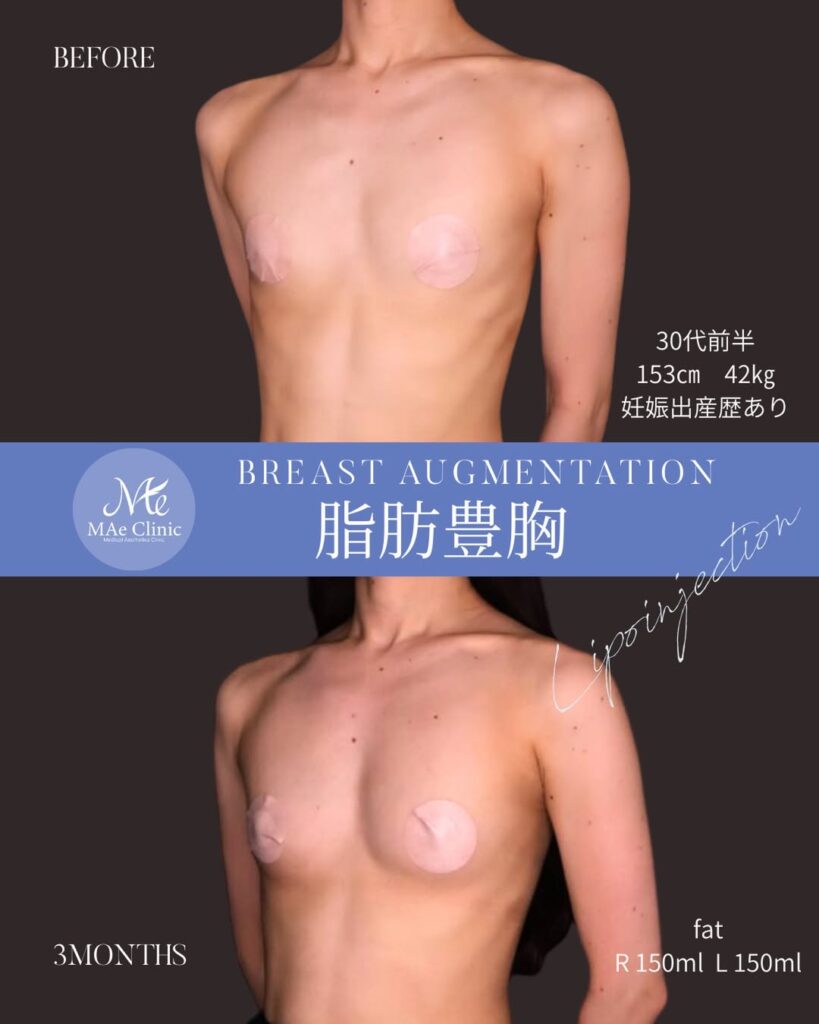 脂肪注入豊胸（遠心分離法） 脂肪採取部位：大腿後面（太もも裏） 注入量：300ml（右150ml / 左150ml） 木下恵里沙医師症例