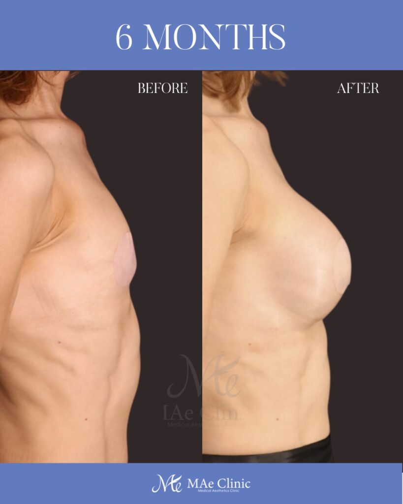 シリコンバッグ豊胸(Motiva Ergonomix2 325ml) 乳腺下留置 乳房下溝切開アプローチ 木下恵里沙医師症例