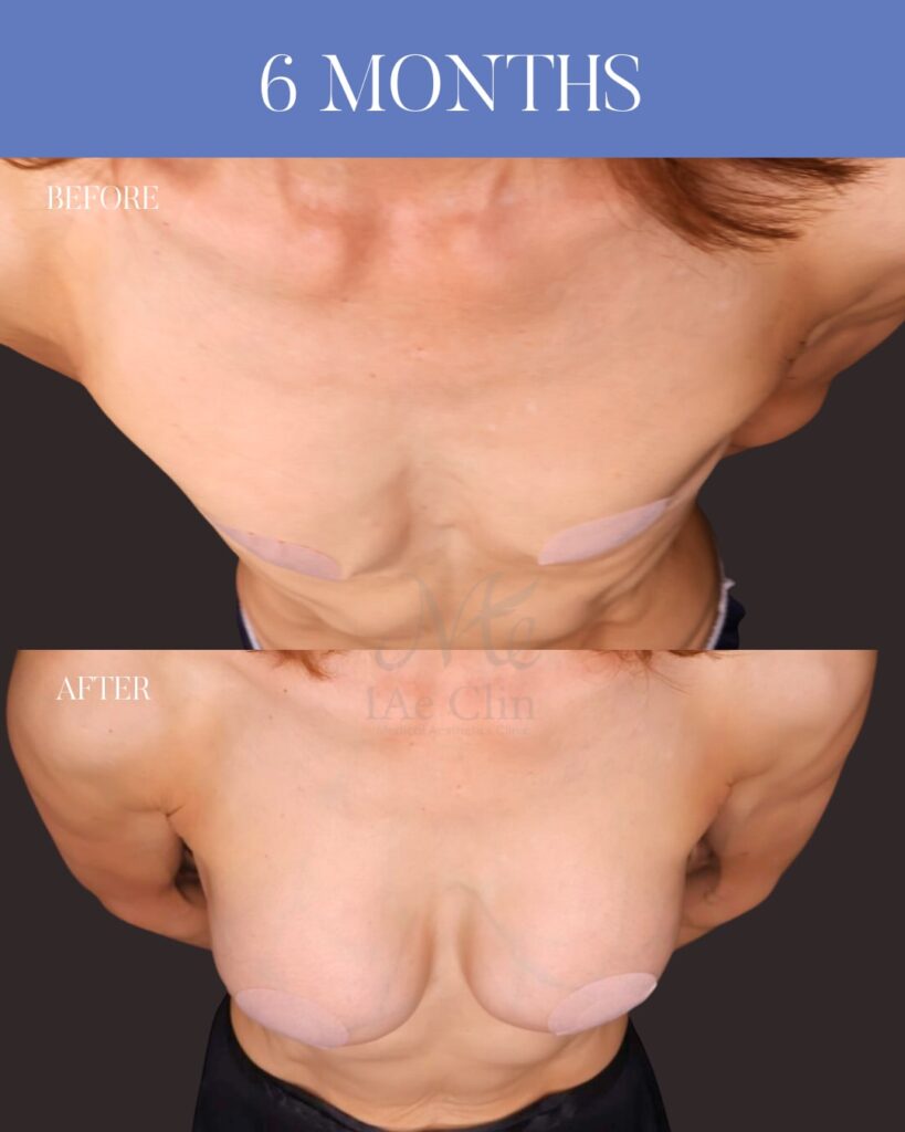 シリコンバッグ豊胸(Motiva Ergonomix2 325ml) 乳腺下留置 乳房下溝切開アプローチ 木下恵里沙医師症例