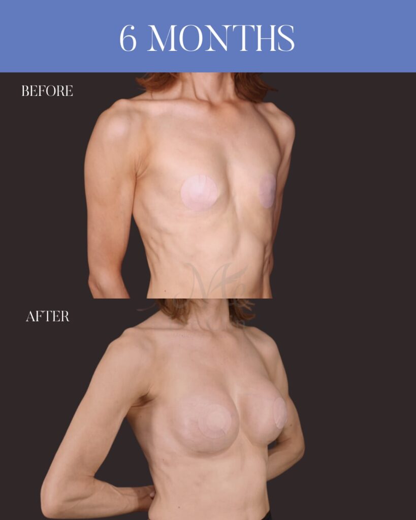 シリコンバッグ豊胸(Motiva Ergonomix2 325ml) 乳腺下留置 乳房下溝切開アプローチ 木下恵里沙医師症例