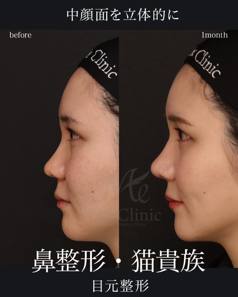 鼻中隔延長(肋軟骨)
鼻尖形成
鼻尖軟骨移植
猫貴族手術(肋軟骨)
目頭切開
埋没法
望月正人医師症例