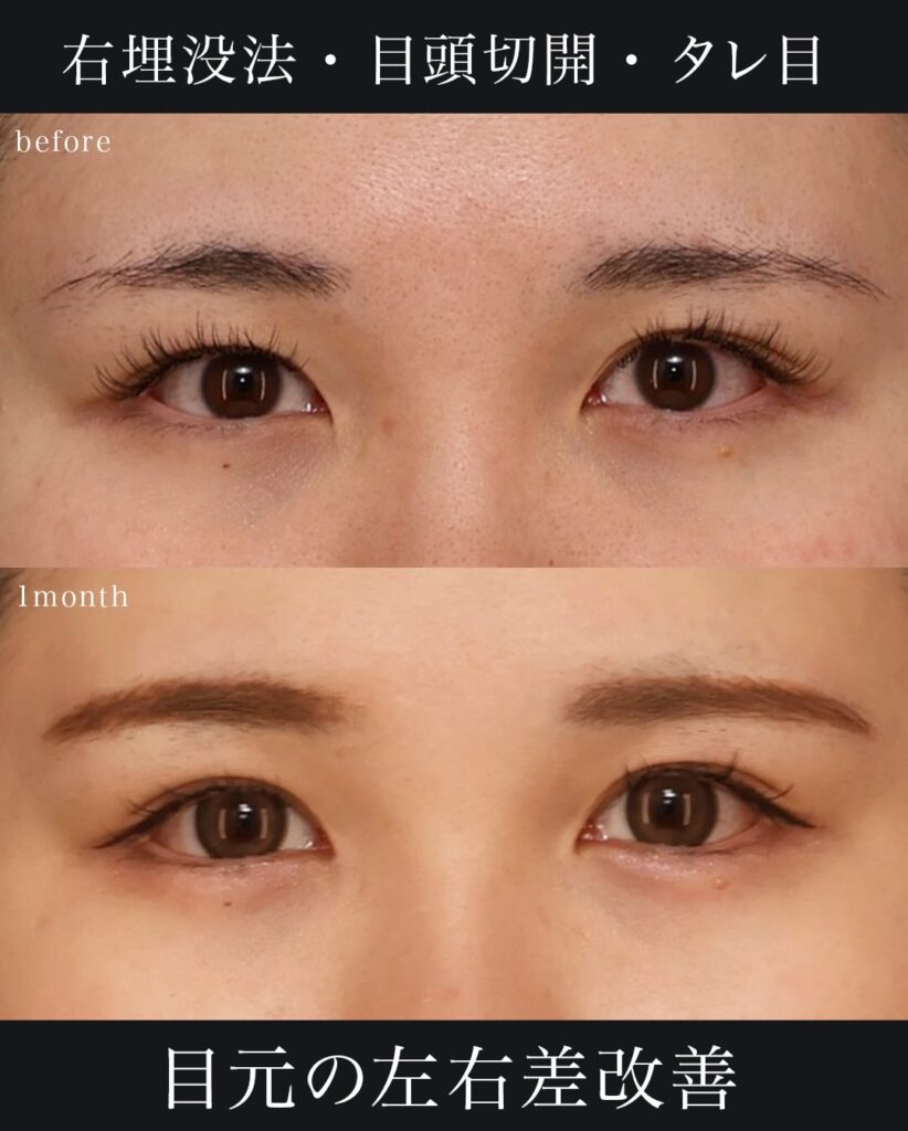 鼻中隔延長(肋軟骨) 鼻尖形成 鼻尖軟骨移植 猫貴族手術(肋軟骨) 目頭切開 埋没法 望月正人医師症例