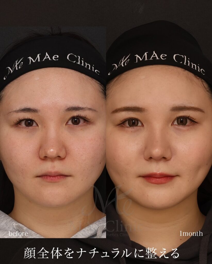 鼻中隔延長(肋軟骨) 鼻尖形成 鼻尖軟骨移植 猫貴族手術(肋軟骨) 目頭切開 埋没法 望月正人医師症例