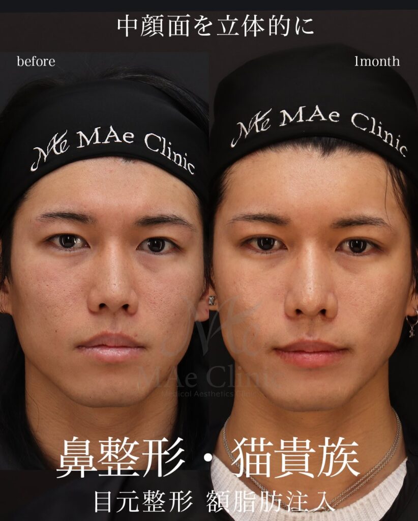 鼻中隔延長（肋軟骨） 鼻尖形成 鼻尖軟骨移植 猫貴族手術（肋軟骨） 二重埋没法 額脂肪注入 望月正人医師症例