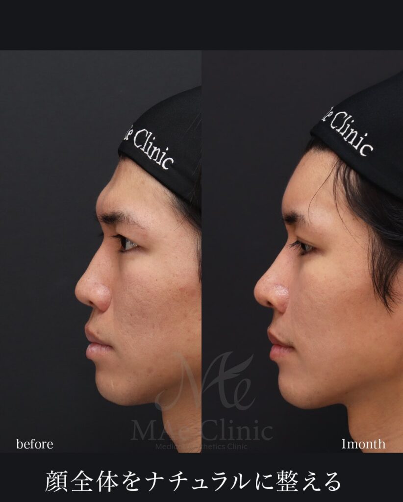 鼻中隔延長(肋軟骨) 鼻尖形成 鼻尖軟骨移植 猫貴族手術(肋軟骨) 二重埋没法 額脂肪注入 望月正人医師症例