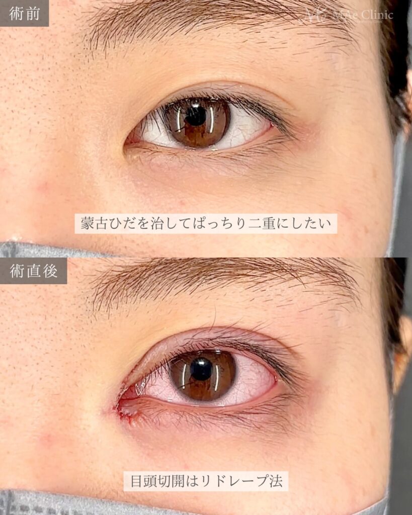 目頭切開(リドレープ法) 二重埋没法(裏留め) 前之園健太医師症例