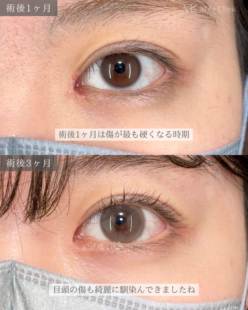 目頭切開(リドレープ法) 二重埋没法(裏留め) 前之園健太医師症例