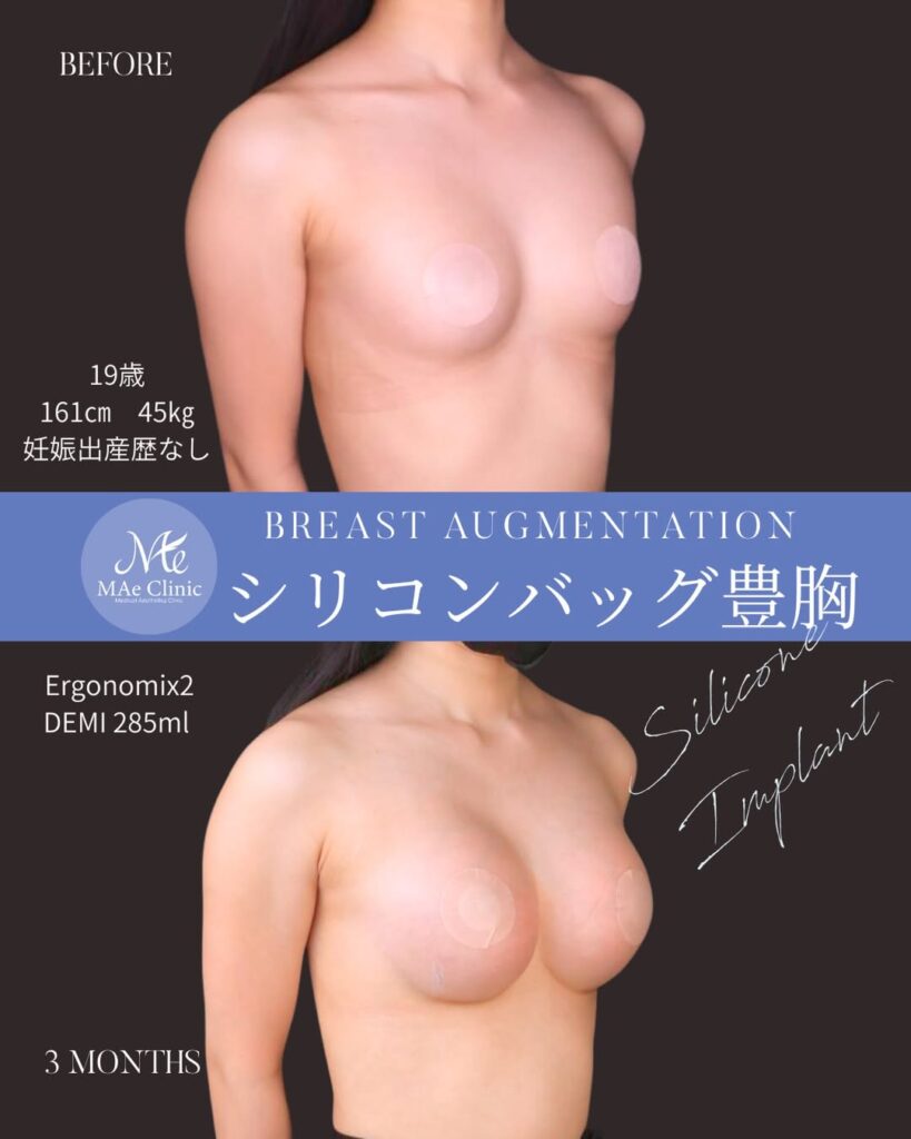 シリコンバッグ豊胸(Motiva Ergonomix2 DEMI)
サイズ:両側285ml
木下恵里沙医師症例