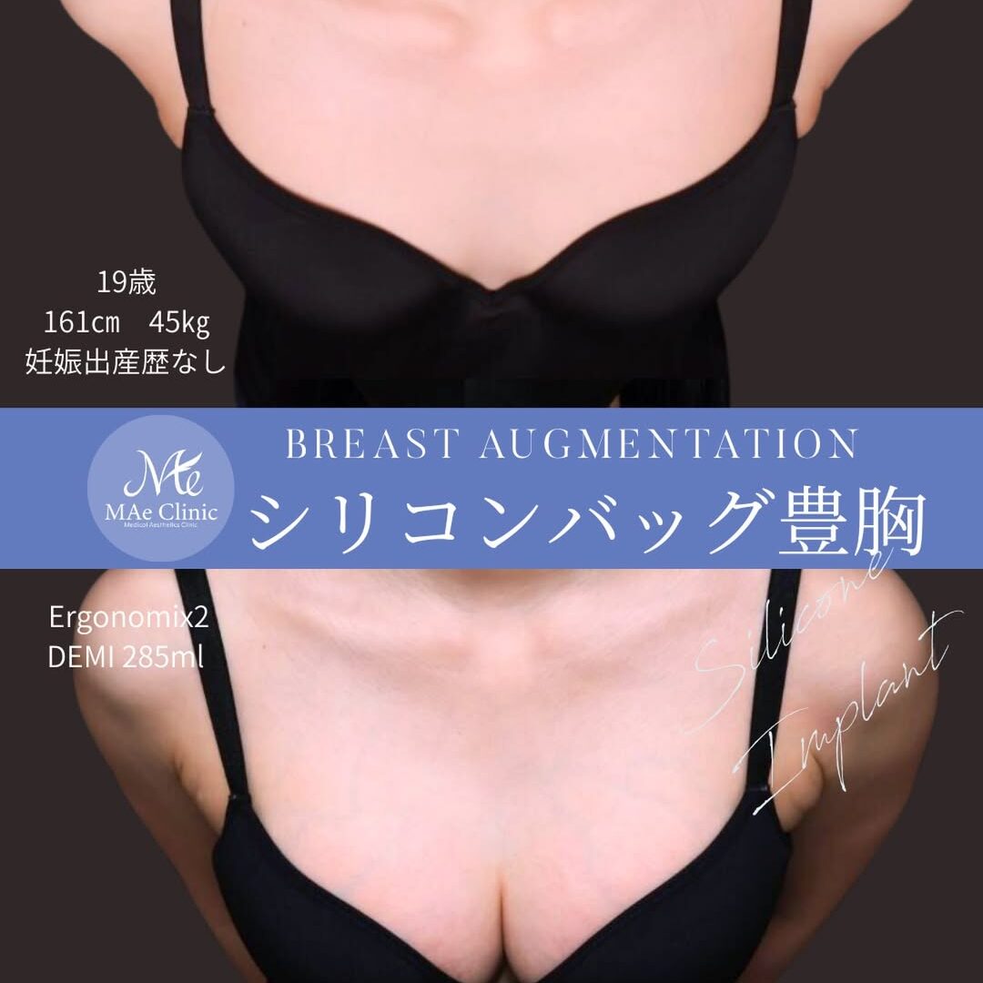 【未使用】脂肪豊胸後 専用下着CHERIAGE Mサイズ 2026030415-1080x1080.jpg
