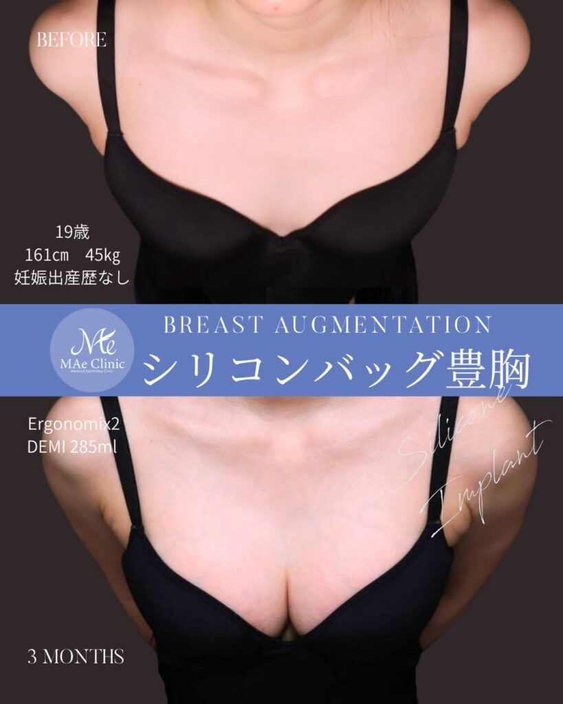 シリコンバッグ豊胸（Motiva Ergonomix2 DEMI） サイズ：両側285ml