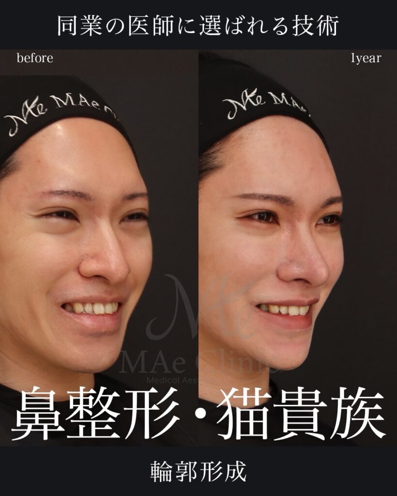 鼻中隔延長(肋軟骨)
鼻尖形成
鼻尖軟骨移植
鼻骨骨切り
猫貴族手術
脂肪注入(額・目の下)
Vライン形成
術後1年
前田翔医師症例