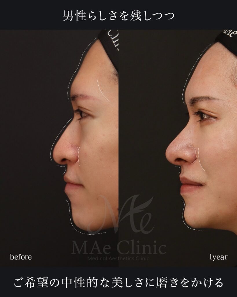 鼻中隔延長(肋軟骨) 鼻尖形成 鼻尖軟骨移植 鼻骨骨切り 猫貴族手術 脂肪注入(額・目の下) Vライン形成 術後1年 前田翔医師症例