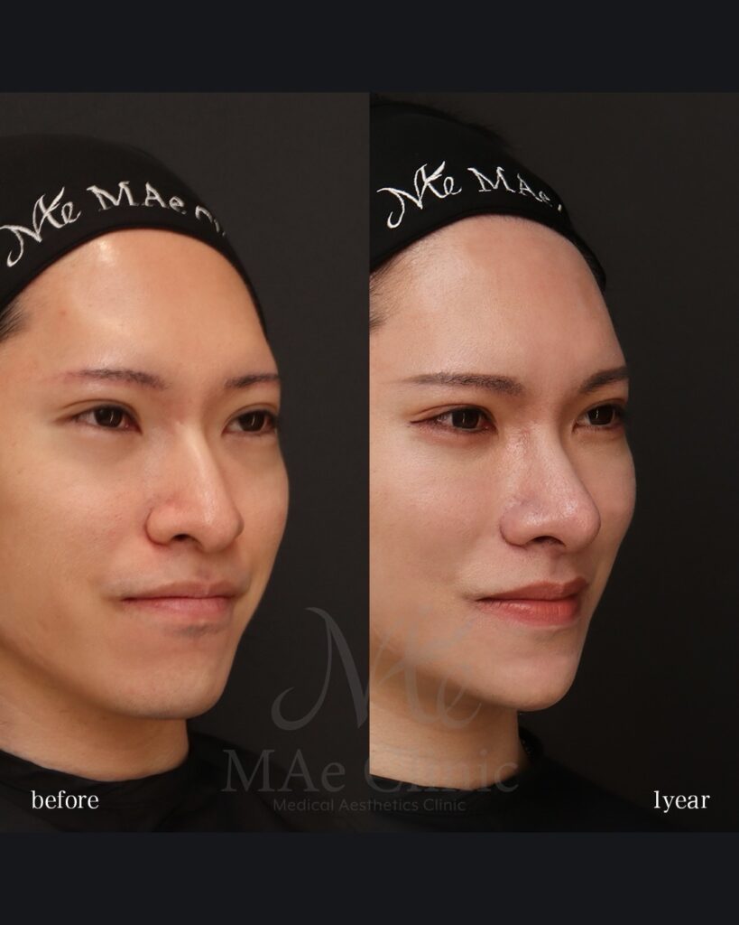 鼻中隔延長(肋軟骨) 鼻尖形成 鼻尖軟骨移植 鼻骨骨切り 猫貴族手術 脂肪注入(額・目の下) Vライン形成 術後1年 前田翔医師症例