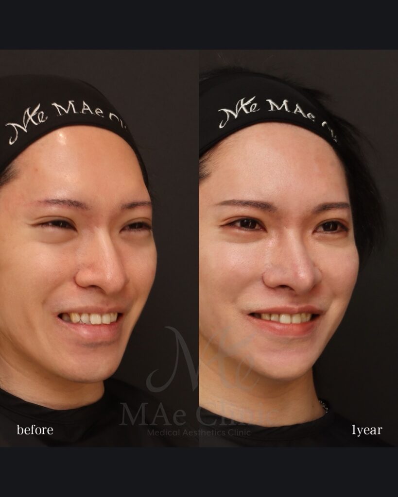 鼻中隔延長(肋軟骨) 鼻尖形成 鼻尖軟骨移植 鼻骨骨切り 猫貴族手術 脂肪注入(額・目の下) Vライン形成 術後1年 前田翔医師症例