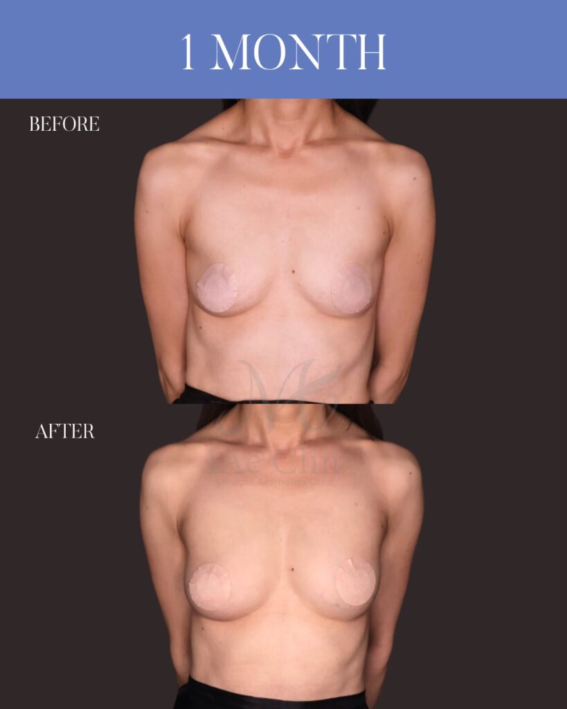 コンデンスリッチ脂肪豊胸(脂肪吸引+脂肪注入) 木下恵里沙医師症例