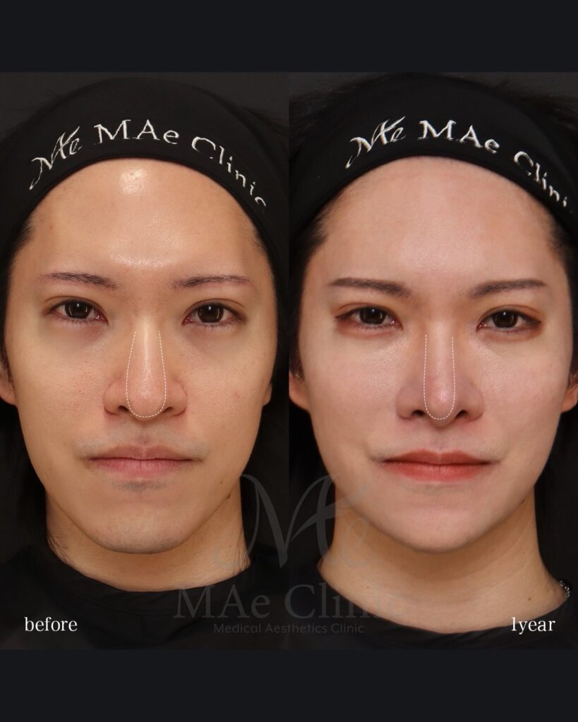 鼻中隔延長(肋軟骨) 鼻尖形成 鼻尖軟骨移植 鼻骨骨切り 猫貴族手術 脂肪注入(額・目の下) Vライン形成 術後1年 前田翔医師症例