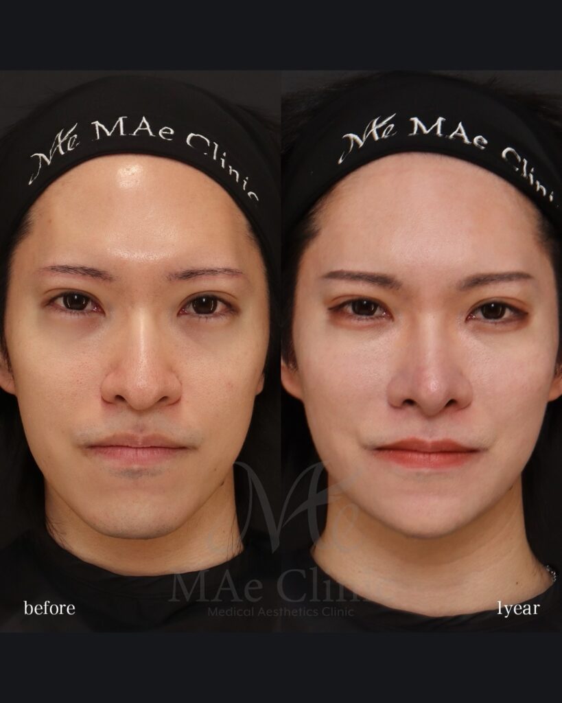 鼻中隔延長(肋軟骨) 鼻尖形成 鼻尖軟骨移植 鼻骨骨切り 猫貴族手術 脂肪注入(額・目の下) Vライン形成 術後1年 前田翔医師症例