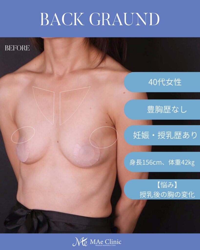 コンデンスリッチ脂肪豊胸(脂肪吸引+脂肪注入) 木下恵里沙医師症例