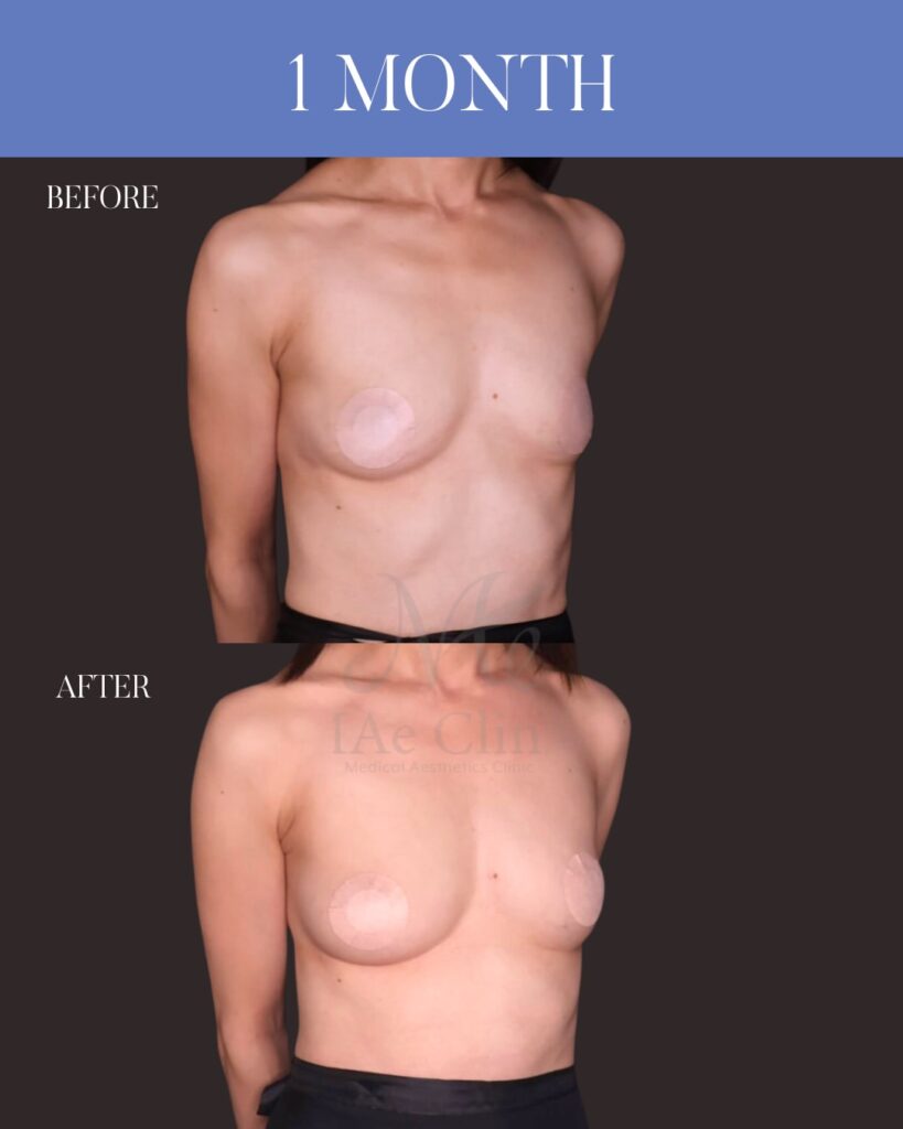 コンデンスリッチ脂肪豊胸(脂肪吸引+脂肪注入) 木下恵里沙医師症例