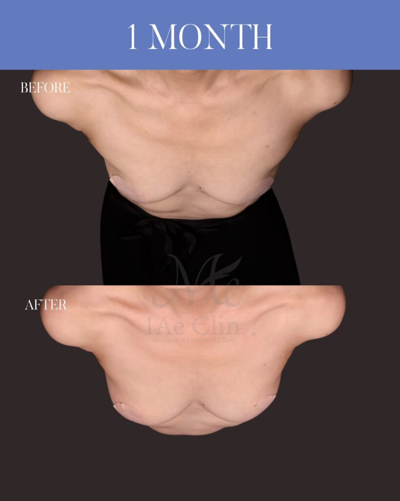 コンデンスリッチ脂肪豊胸(脂肪吸引+脂肪注入) 木下恵里沙医師症例