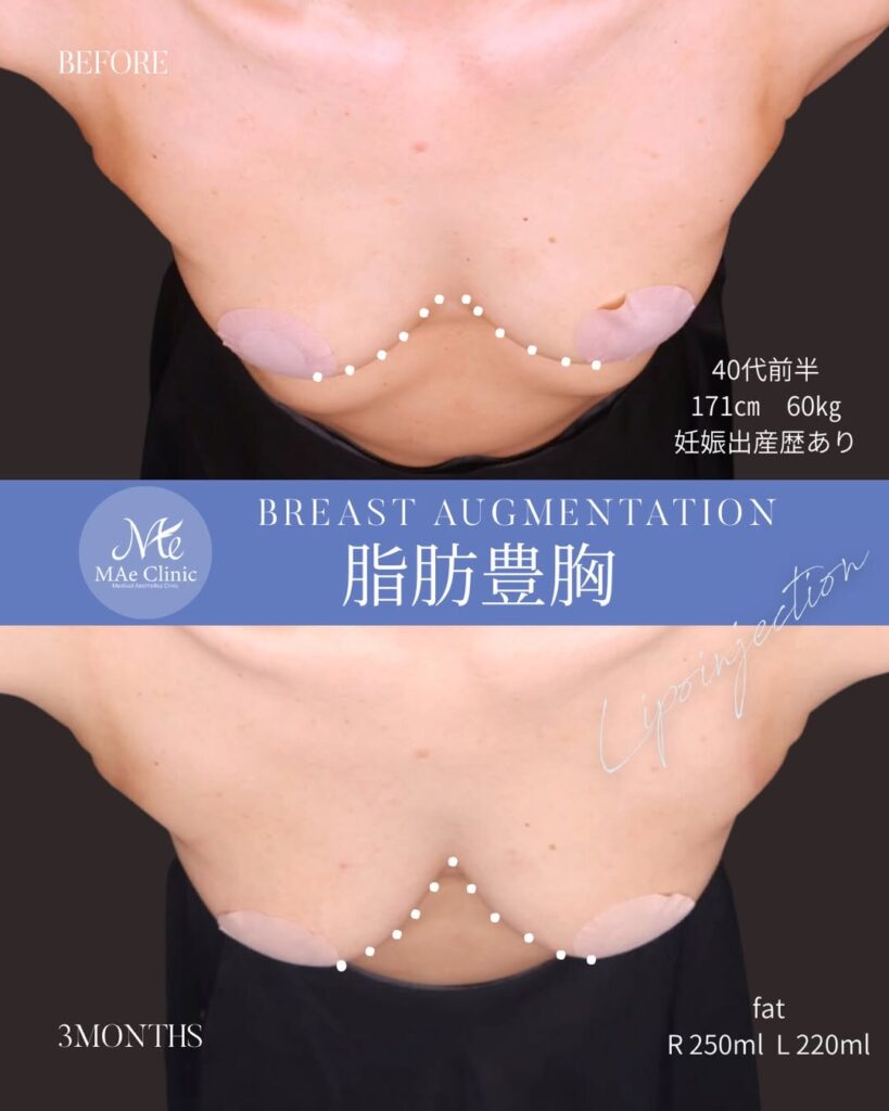 コンデンスリッチ脂肪豊胸 採取部位:大腿前面 処理方法:コンデンスリッチ法 注入量:右250ml・左220ml(Total 470ml) 木下恵里沙医師症例