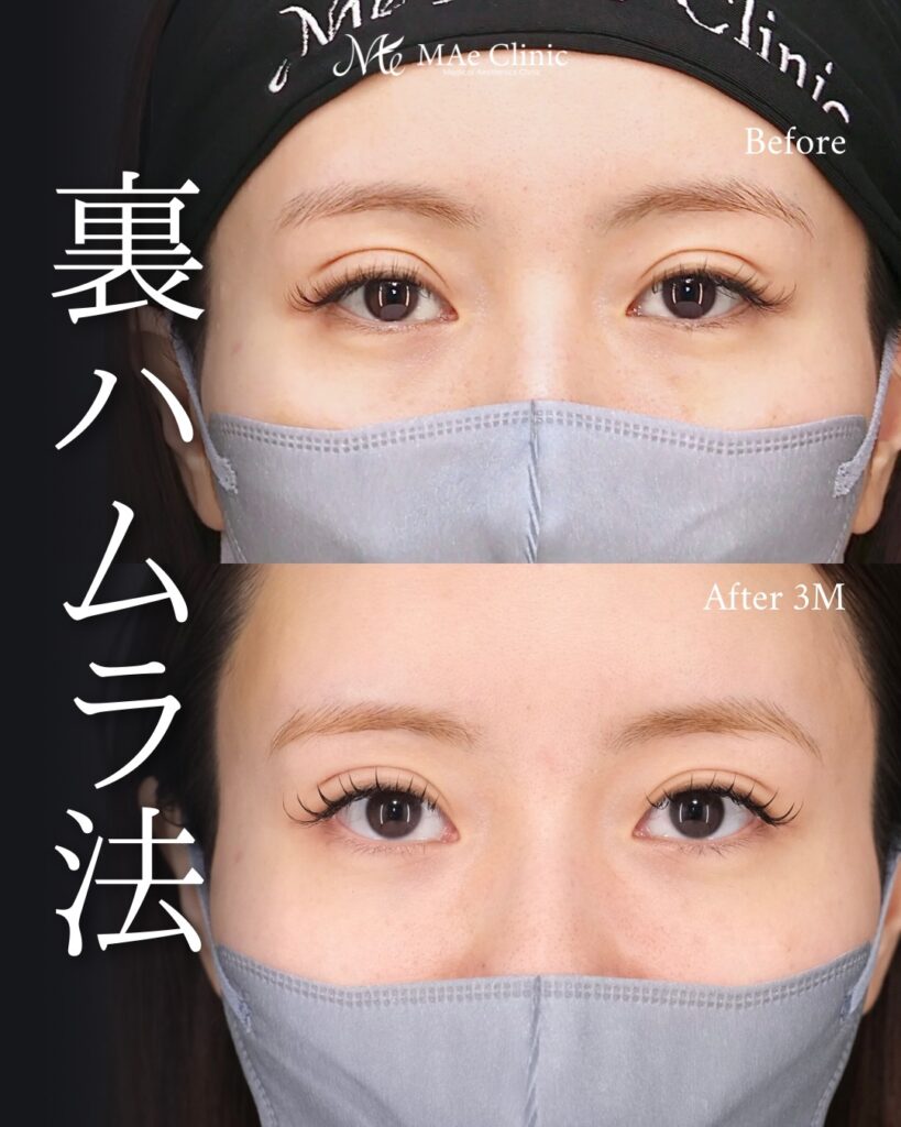 裏ハムラ法 前之園健太医師症例