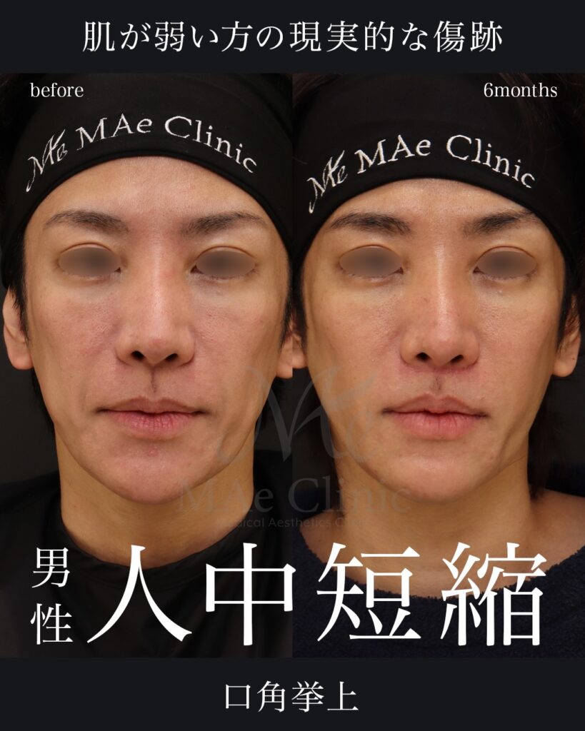 人中短縮術(切開法)
人中厚み調整3D
口角挙上術
前田翔医師症例