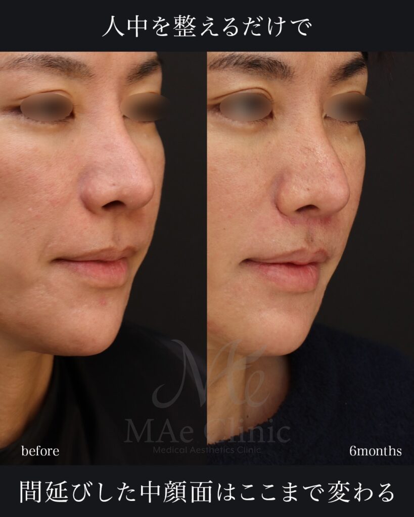 人中短縮術(切開法) 人中厚み調整3D 口角挙上術 前田翔医師症例