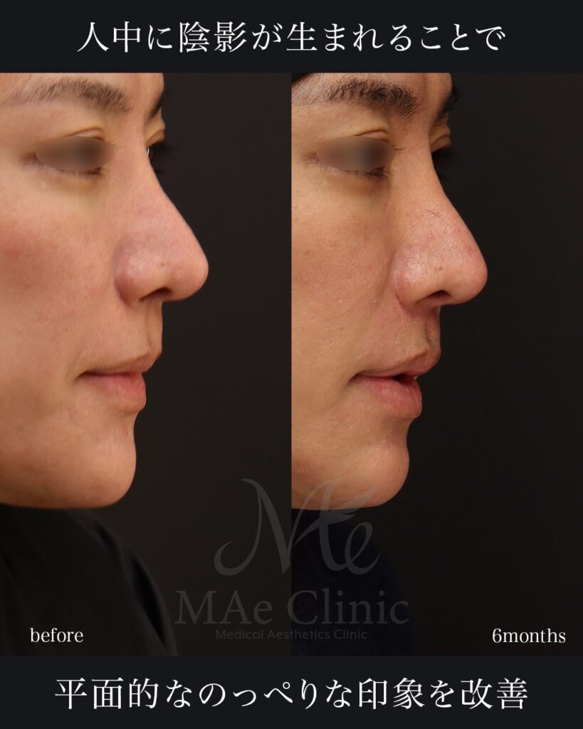 人中短縮術(切開法) 人中厚み調整3D 口角挙上術 前田翔医師症例