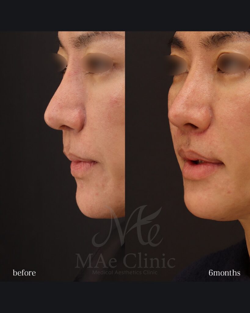 人中短縮術(切開法) 人中厚み調整3D 口角挙上術 前田翔医師症例