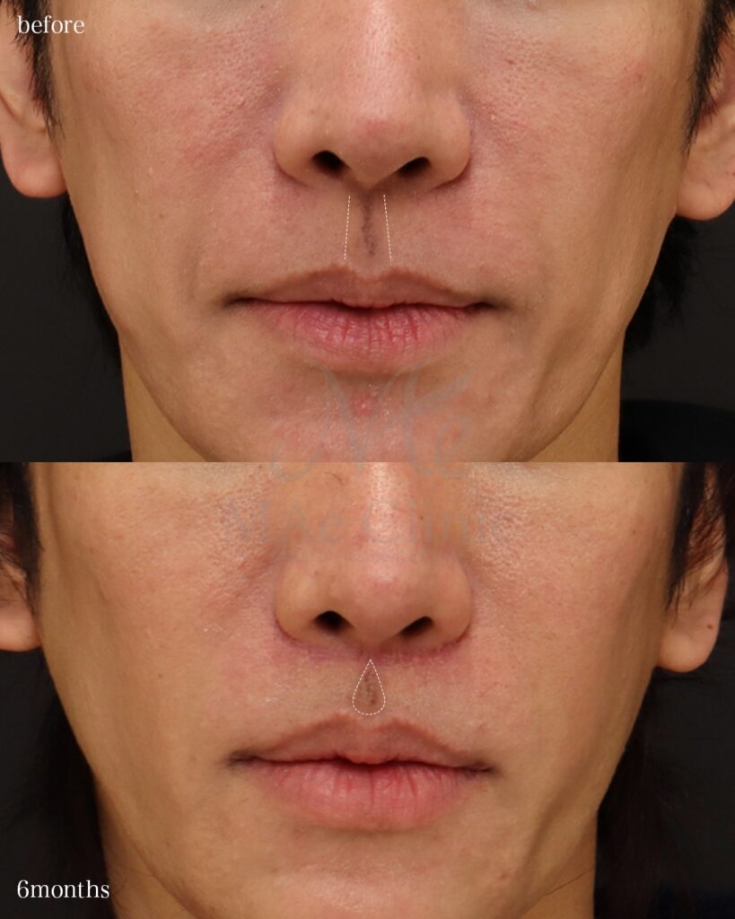 人中短縮術(切開法) 人中厚み調整3D 口角挙上術 前田翔医師症例