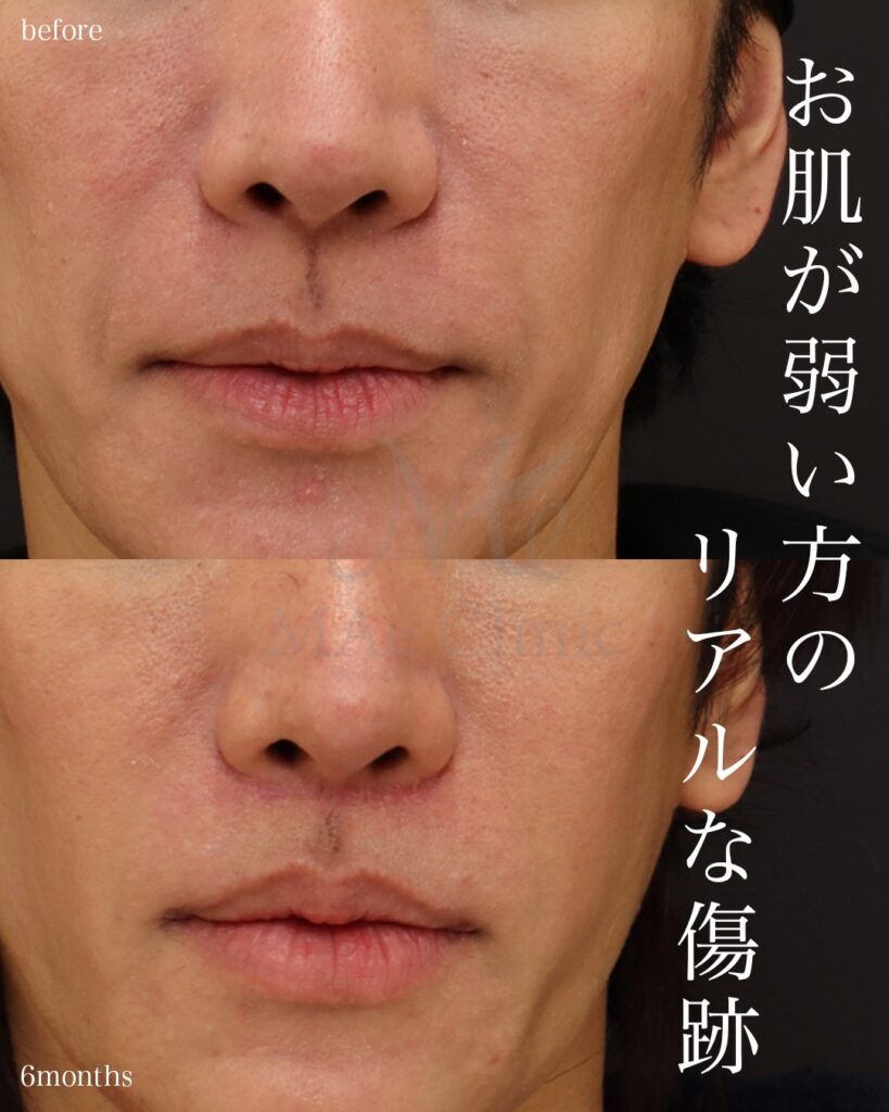 人中短縮術(切開法) 人中厚み調整3D 口角挙上術 前田翔医師症例