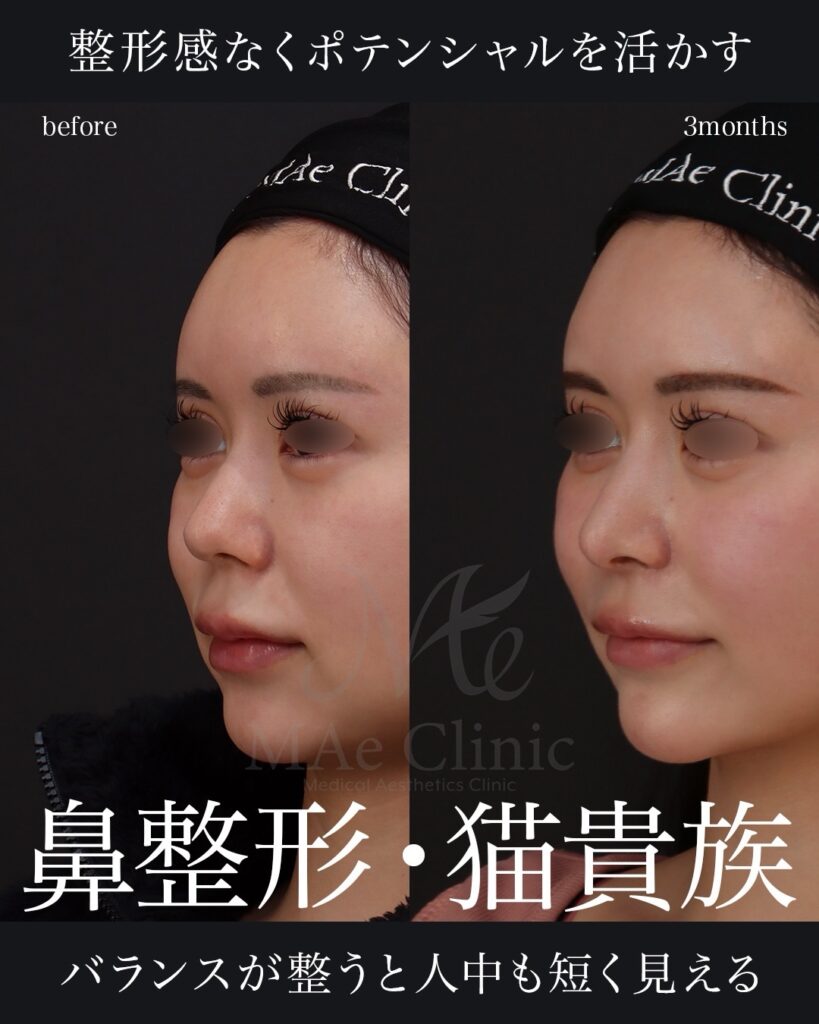 鼻中隔延長（肋軟骨）
鼻尖形成
鼻尖軟骨移植
鼻背細片軟骨移植（隆鼻術）
猫貴族手術（肋軟骨）
鼻翼縮小（内側）
前田翔医師症例